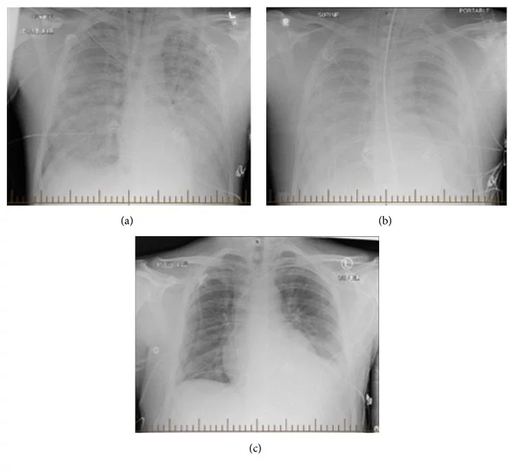 Chantavirusnyj kardiopulmonalnyj sindrom Hantavirus pulmonary syndrome Chantavirusny lohačny sindrom